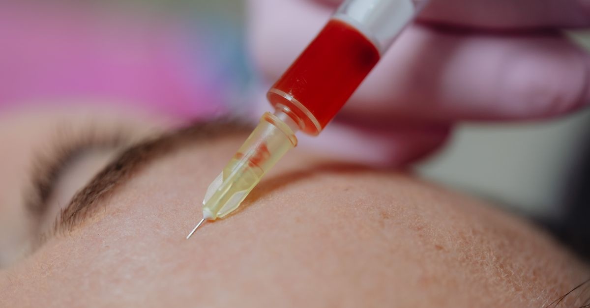 Blask bez filtra: hybrydowe mikroigłowanie z osoczem – naturalny reset skóry