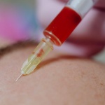 Blask bez filtra: hybrydowe mikroigłowanie z osoczem – naturalny reset skóry